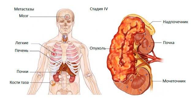 Объемное образование на левой или правой почке: симптомы и лечение