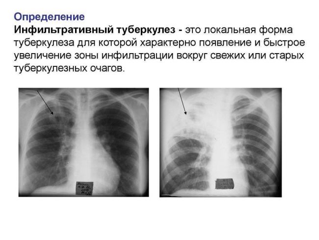 Очаговый туберкулез легких