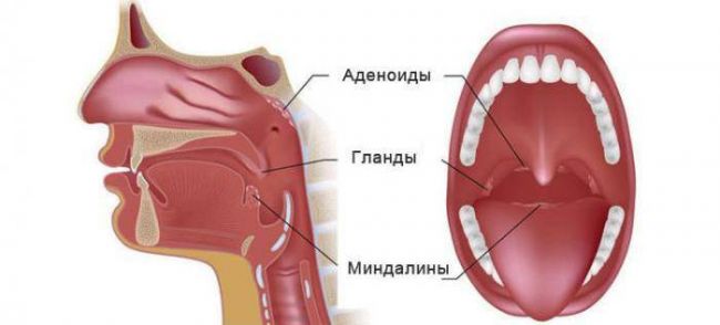 Лечение хронического тонзиллита у детей