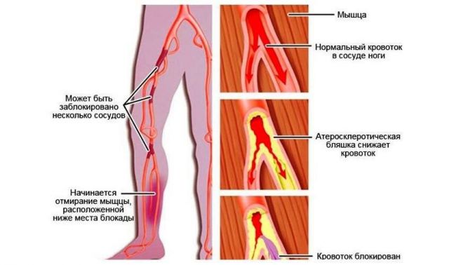 Облитерирующий эндартериит