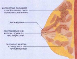 Симптомы мастита