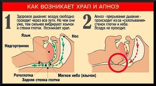 Храп у мужчин можно ли от него избавиться
