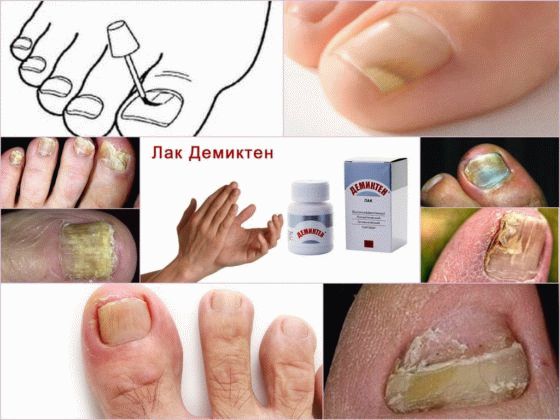 Лак от грибка ногтей демиктен