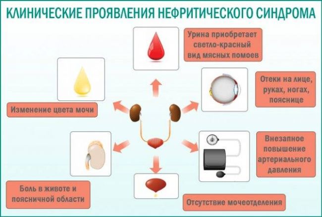 Нефротический синдром: патогенез, симптоматика, диагноз, как лечить