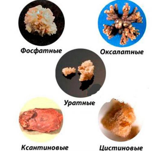 Эффективные таблетки и капли для выведения камней из почек