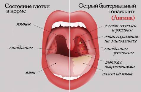 Гнойная ангина у детей и ее лечение: что делать родителям для быстрого выздоровления малыша