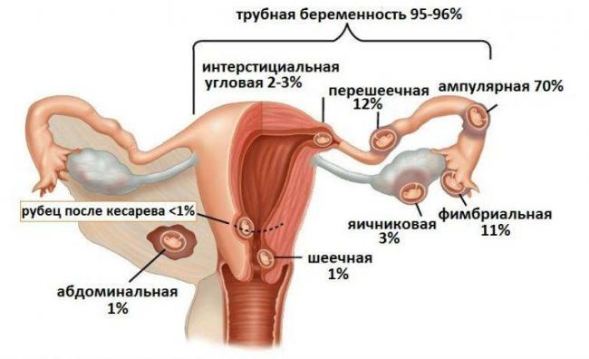 Внематочная беременность: признаки и симптомы, как определить на ранних сроках / mama66.ru