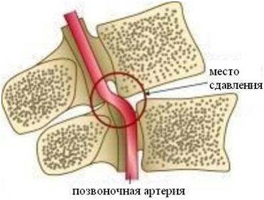 Сколько дней температура при остеохондрозе?