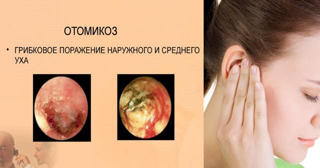 Какие противогрибковые капли в уши лучше для людей