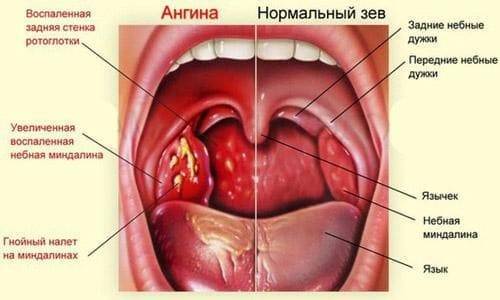 Лакунарная ангина