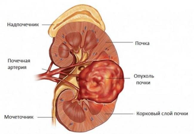 Причины роста кисты почки | советы доктора