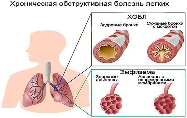 Отказали инвалидность бронхиальная астма