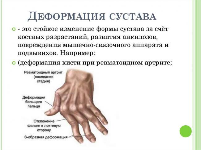 Причины, симптомы и лечение остеоартроза суставов