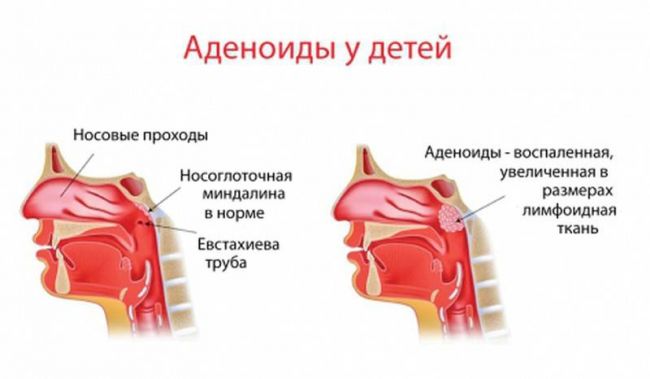 Самые эффективные средства для лечения аденоидов у детей без операции