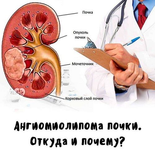 Особенности возникновения ангиомиолипомы и ее локализация