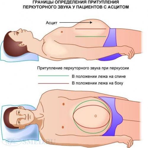 Можно ли вылечить асцит брюшной полости при циррозе печени, как правильно лечить?