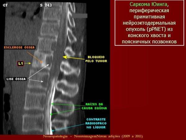 Шишка на пояснице слева от позвоночника под кожей