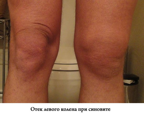 Синовит коленного сустава: симптомы, лечение, полное описание заболевания