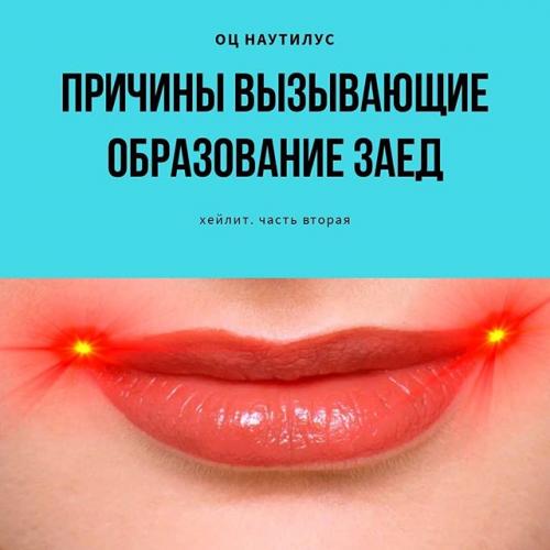 Кандидозные заеды в уголках рта и их лечение