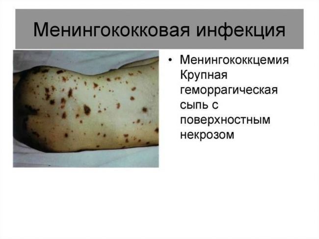 Назофарингит