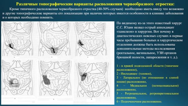 Острый аппендицит
