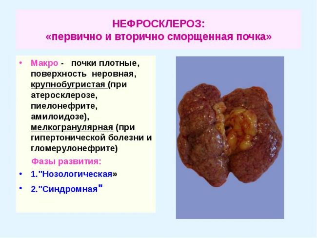Особенности нефросклероза и способы лечения усохшей почки