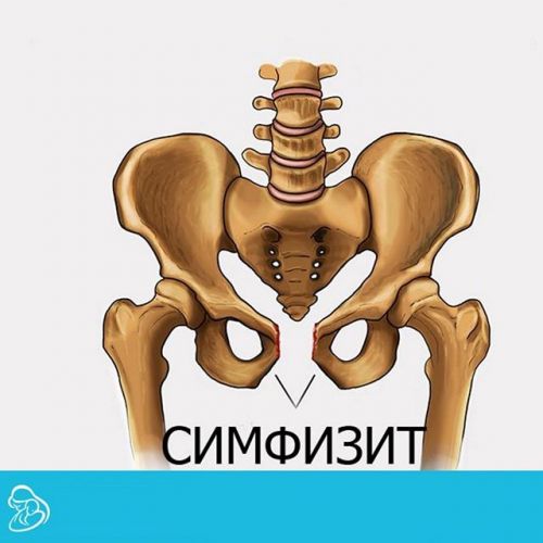 Симптомы симфизита при беременности, профилактика и лечение