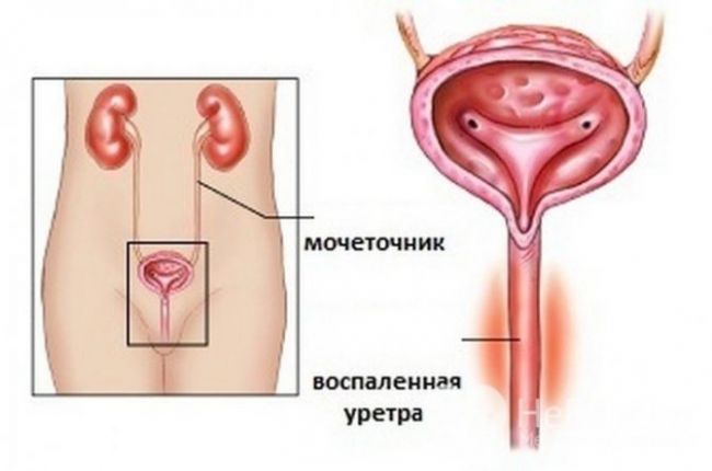 Современная диагностика уретрита