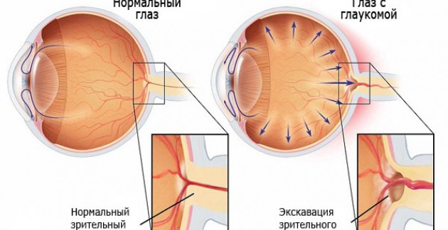 Внутриглазное давление — симптомы и лечение