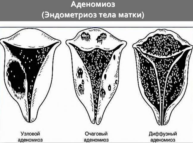 Является ли аденомиоз матки раком