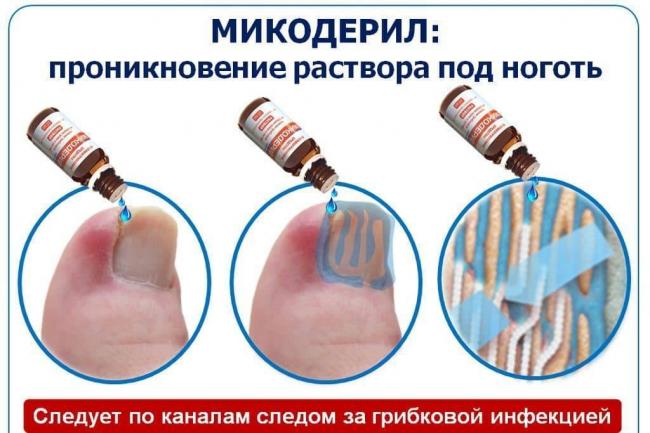 Micoderm от грибка: мгновенно действует, активно уничтожая микробы!