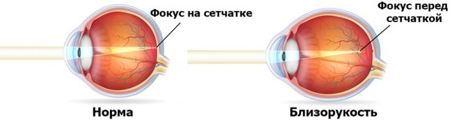 Астигматизм