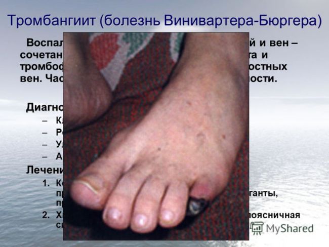 Что такое болезнь бюргера и как она лечится