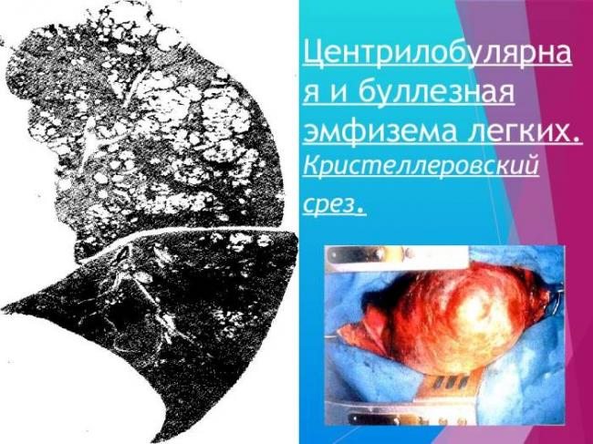 Другие интерстициальные легочные болезни