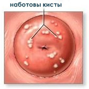Киста на шейке матки - что это такое, чем опасна. лечение кисты на шейке матки