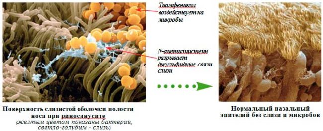 Флуимуцил ит антибиотик для ингаляций. инструкция по применению, как разводить