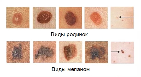 Опухоль: что это такое, виды, причины, симптомы и классификация