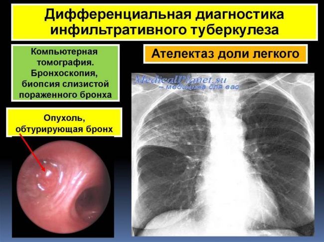 Инфильтративный туберкулез легких - симптомы болезни, профилактика и лечение инфильтративного туберкулеза легких, причины заболевания и его диагностика на eurolab