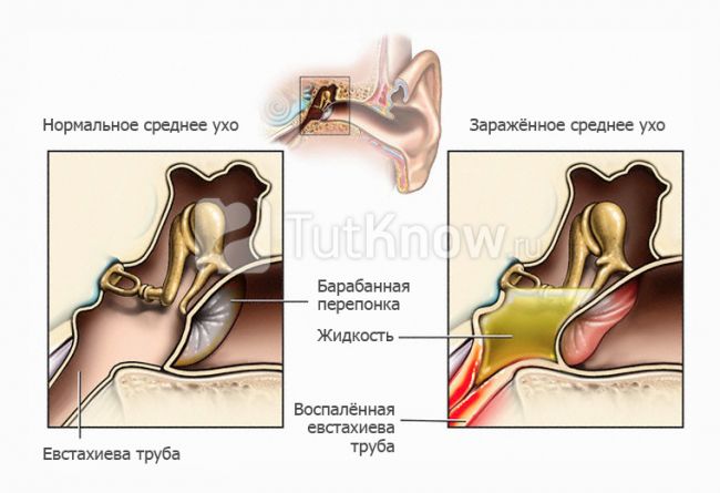 Заложило ухо после простуды: что делать, как лечить в домашних условиях