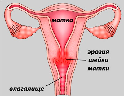 Дисбактериоз влагалища: симптомы