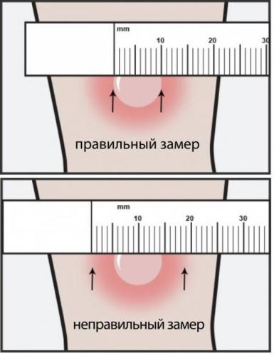Что делать, если у ребенка большая и красная манту: почему бывает плохая реакция и гиперемия?