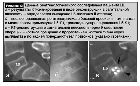 Спондилодез поясничного отдела позвоночника операция