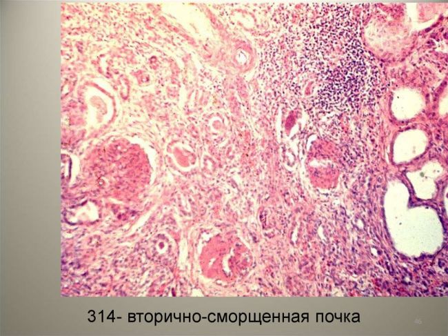 Сморщенная почка: как определить болезнь по симптомам и что делать при ее лечении?