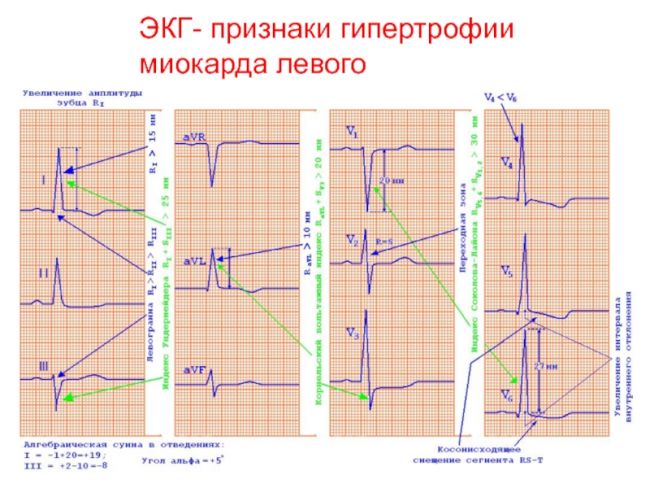 Гипертрофия левого желудочка сердца: что это, симптомы, лечение