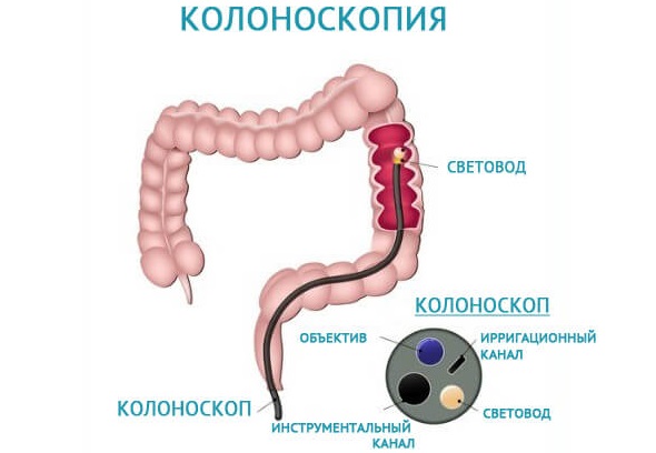 Диета после удаления спаек кишечника