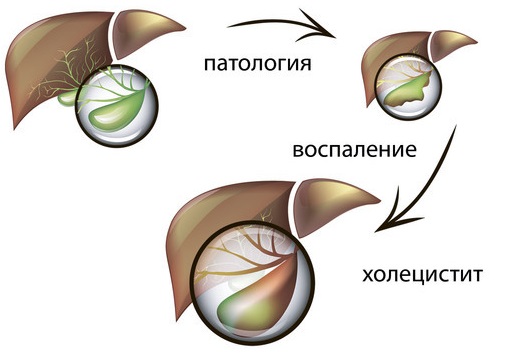 Хронический холецистит