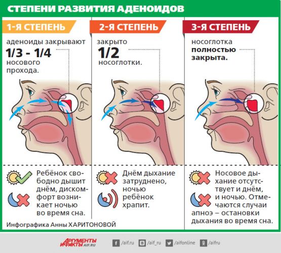 Симптомы и лечение аденоидита у детей: распознать и обезвредить!