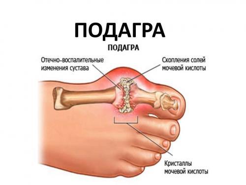 5 овощей, которые помогут снизить уровень мочевой кислоты