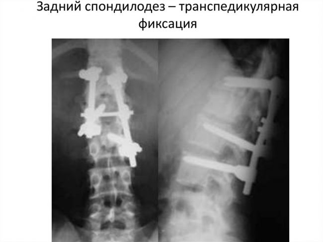 Метод корпородеза при операциях на позвоночник - риски и недостатки