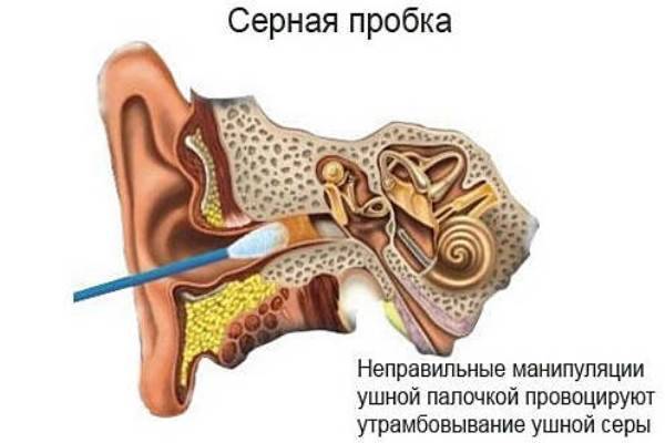Пробка в ухе: как удалить в домашних условиях
